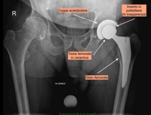 Le componenti che costituiscono una protesi d'anca