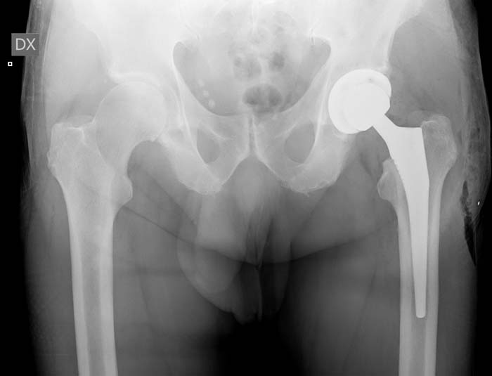 protesi-anca-sinistra